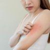 Remedii eficiente pentru alergia la soare – ce este alergia la soare