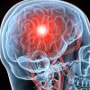 Senzor implantat în creier care ar putea detecta cancerul