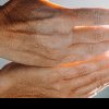 Ce boli pot fi observate privind mâinile? Semne de avertizare și importanța consultului medical