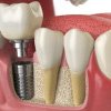 Implanturile Dentare: O Soluție Modernă pentru Sănătatea Orală