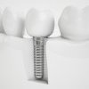 Implantul dentar şi restabilirea sănătăţii orale